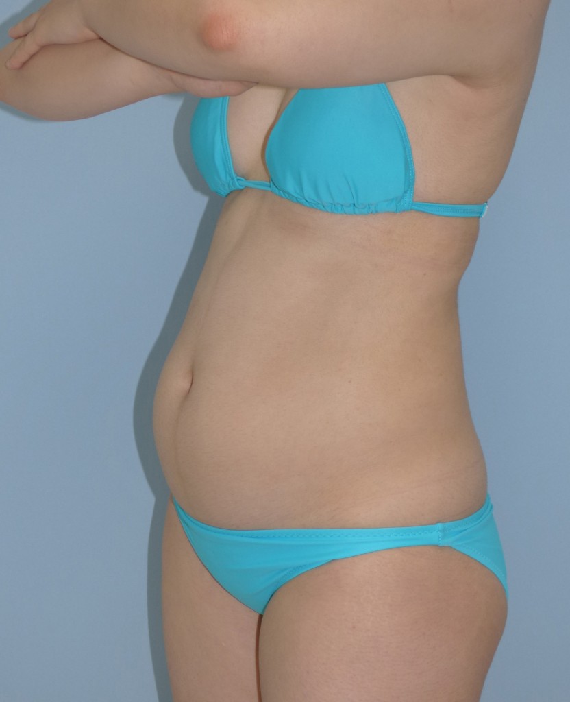お腹の脂肪吸引 23歳 女性 167cm 65kg 院長 内浦康信ブログ