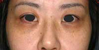 目のくま-経結膜的眼窩脂肪移動術（トラコンハムラ）の症例写真（治療前）