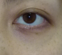目のくま-トレチノイン治療とQスイッチレーザーの症例写真（ライトアイズウルトラ注射１回後）
