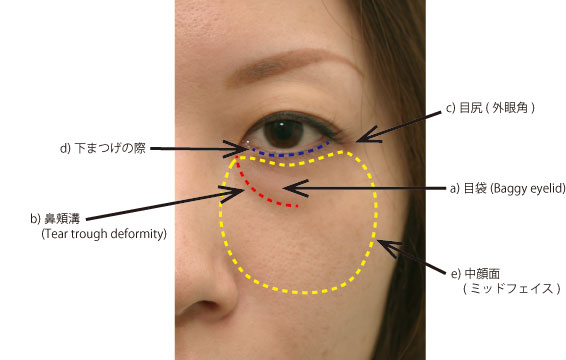 目の周り参考写真