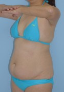 No.055 上下腹 腰の施術内容と症例写真