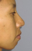 No.001 鼻尖縮小（鼻先縮小）の施術内容と症例写真