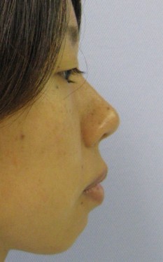 No.001 鼻尖縮小（鼻先縮小）の施術内容と症例写真