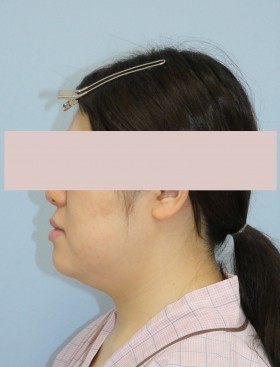 No.004 顔の脂肪吸引の施術内容と症例写真