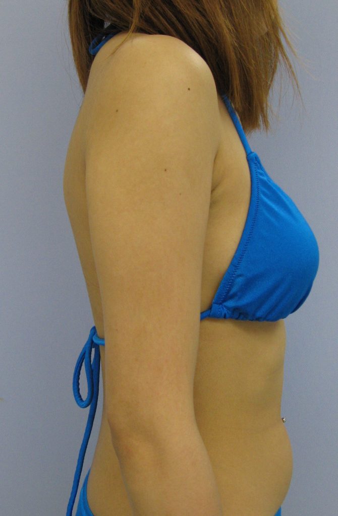二の腕 - 脂肪吸引 症例写真（手術後8ヵ月）（横）