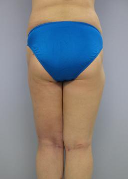 太もも - 脂肪吸引 症例写真（手術後1ヵ月）（後面）