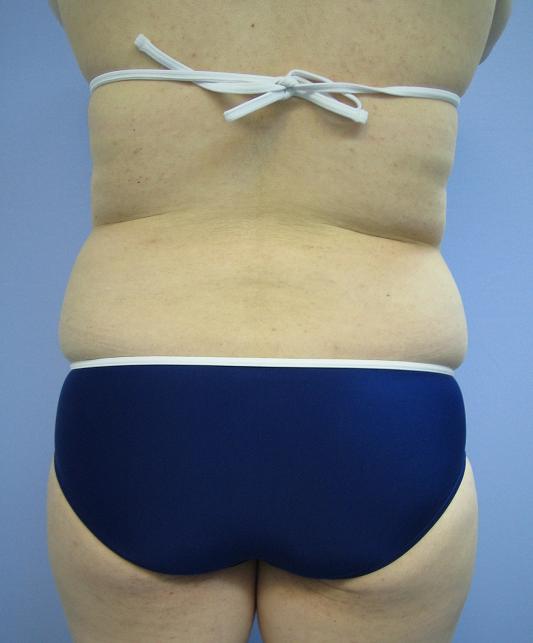お腹 - 脂肪吸引 症例写真（手術前）（後面）