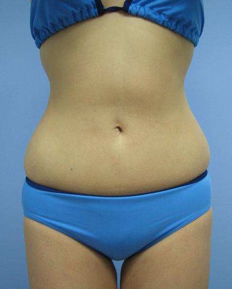 お腹 - 脂肪吸引 症例写真（手術後6ヵ月）（正面）