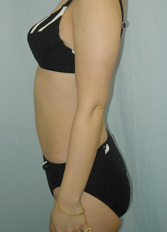 お腹 - 脂肪吸引 症例写真（手術後1ヵ月）（横）