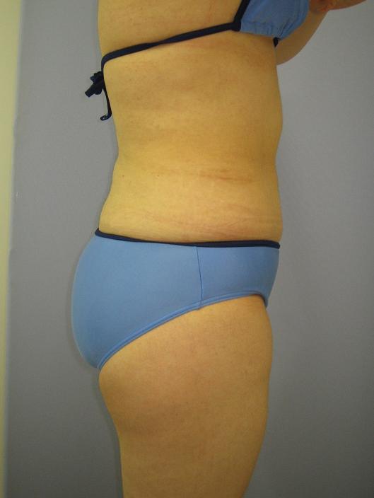 お腹 - 脂肪吸引 症例写真（手術後9ヵ月）（横）