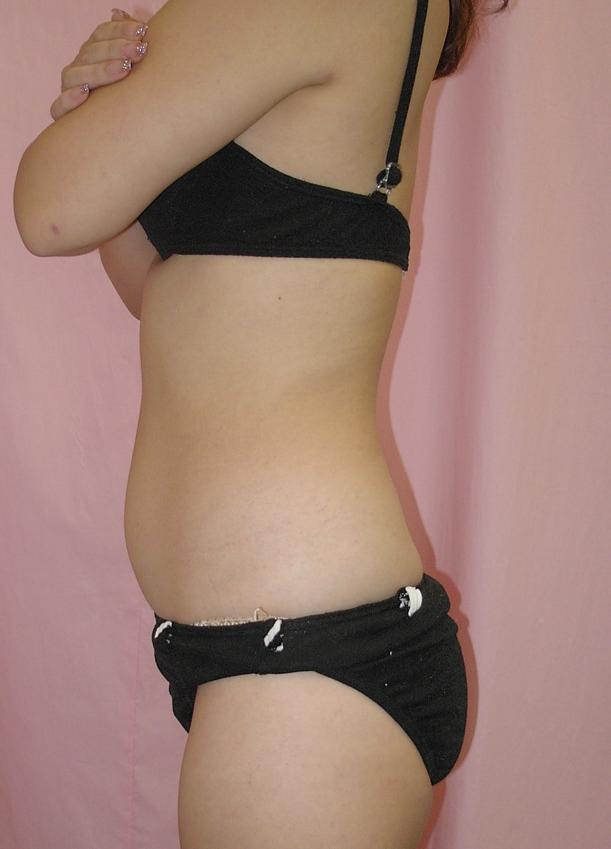 お腹 - 脂肪吸引 症例写真（手術前）（横）