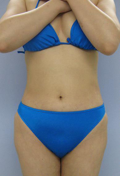 お腹の脂肪吸引　33歳 女性 162cm 54kg