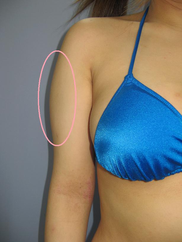 二の腕 - 脂肪吸引 症例写真（ピンク印）（正面）