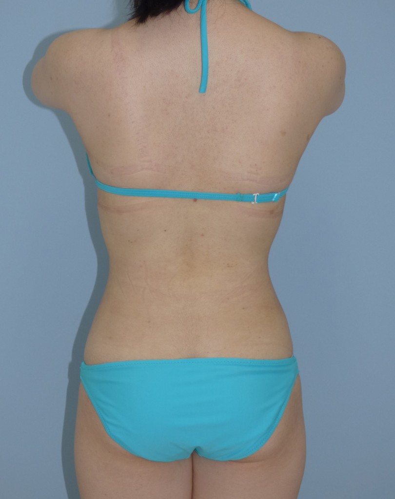 お腹 - 脂肪吸引 症例写真（手術後15ヵ月）（後面）