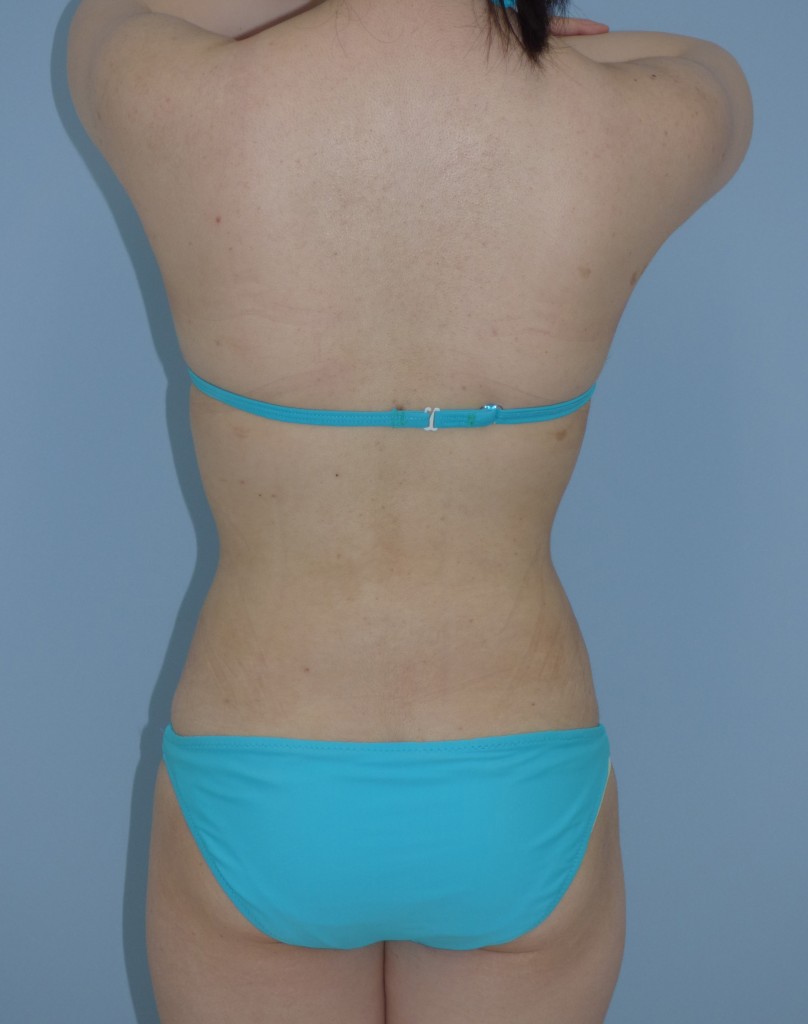 お腹 - 脂肪吸引 症例写真（手術後1ヵ月）（後面）