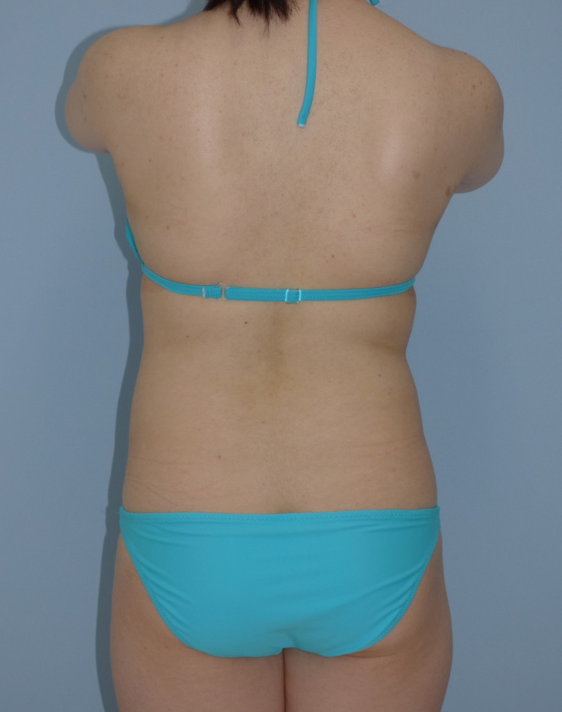 お腹 - 脂肪吸引 症例写真（手術前）（後面）