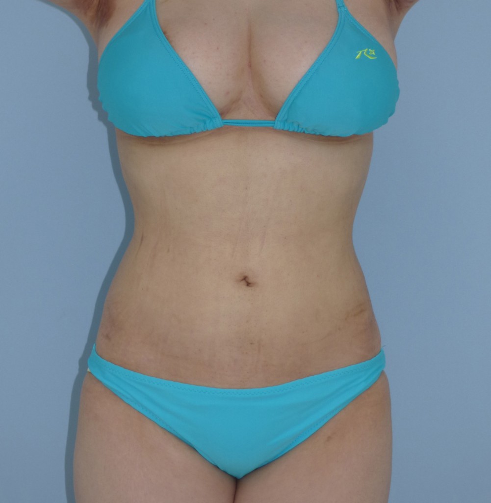 お腹 - 脂肪吸引 症例写真（手術後1ヵ月）（正面）