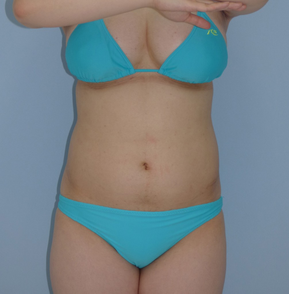 お腹の脂肪吸引　21歳 女性 160cm 63kg