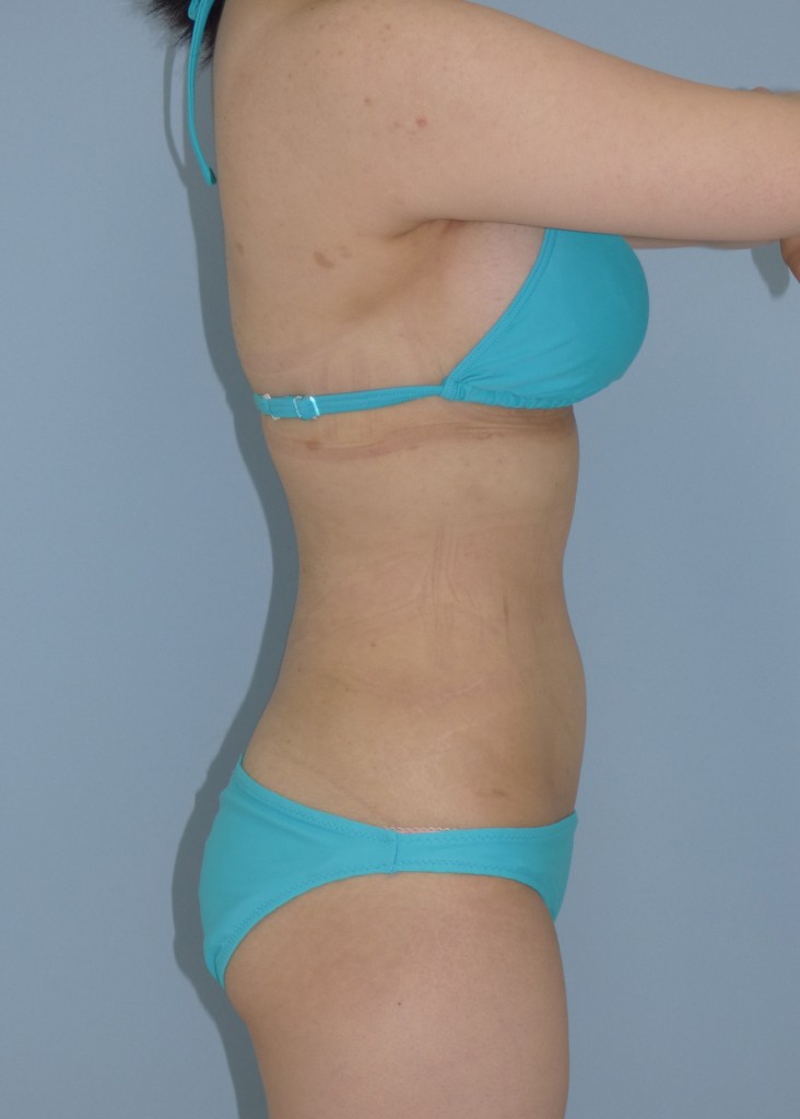 お腹 - 脂肪吸引 症例写真（手術後15ヵ月）（横）