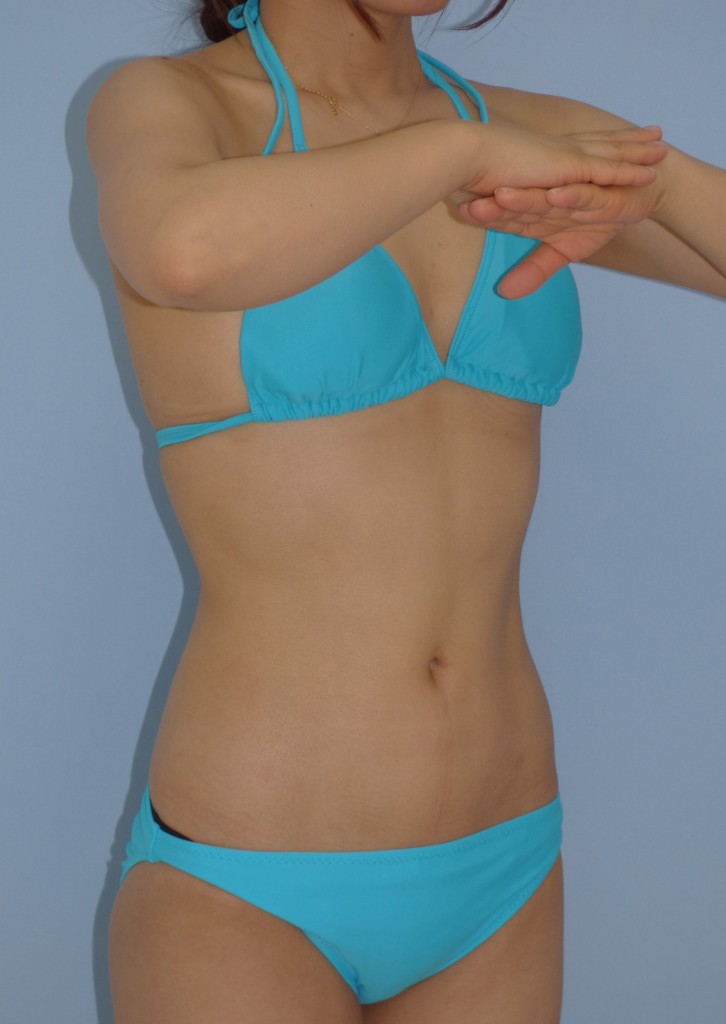 お腹 - 脂肪吸引 症例写真（手術後3ヵ月）（斜め）