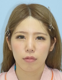 顔 - 脂肪吸引 症例写真（手術後6ヵ月）（正面）