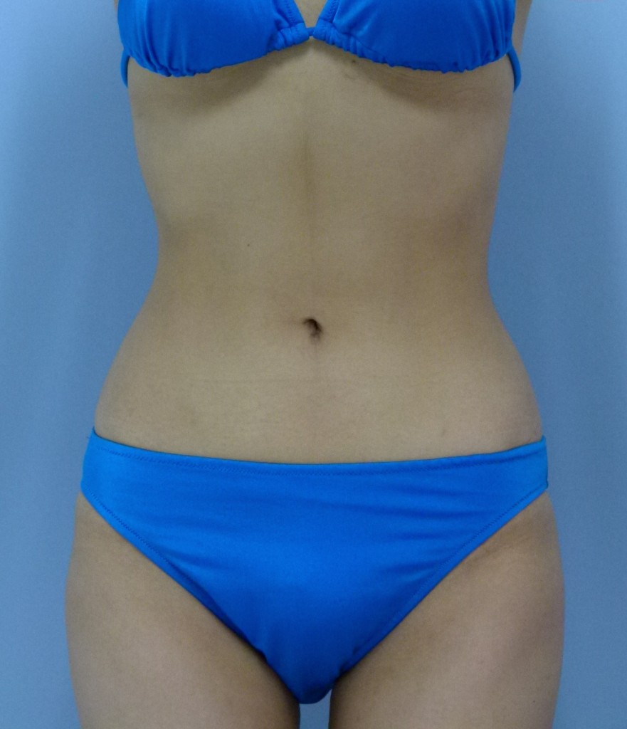 お腹 - 脂肪吸引 症例写真（手術後3ヶ月）（正面）