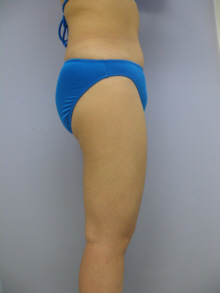 太もも - 脂肪吸引 症例写真（手術後9ヵ月）（横）
