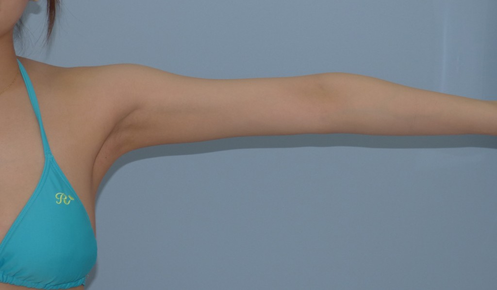 二の腕 - 脂肪吸引 症例写真（手術後3ヶ月）（拳上）
