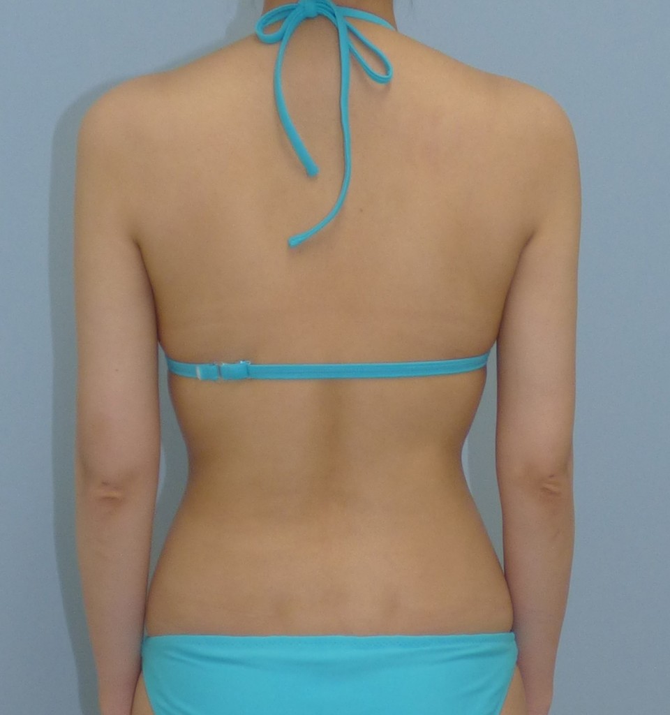 二の腕 - 脂肪吸引 症例写真（手術後3ヶ月）（後面）