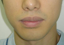 唇の整形：上唇を薄く