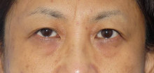 上まぶたのたるみ取り 眉毛下皮膚切除 目の手術 院長 内浦康信ブログ 脂肪吸引ならクリニック日比谷 上まぶたのたるみ取り 眉毛下皮膚切除 目の手術 院長 内浦康信ブログ 脂肪吸引ならクリニック日比谷