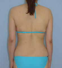 お腹 - 脂肪吸引 症例写真（手術後9ヵ月）（後面）