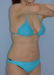 お腹 - 脂肪吸引 症例写真（手術後9ヵ月（斜め）