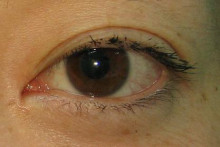 目頭切開 数種類の術式 目の手術 院長 内浦康信ブログ 脂肪吸引ならクリニック日比谷 目頭切開 数種類の術式 目の手術 院長 内浦康信ブログ 脂肪吸引ならクリニック日比谷