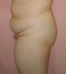 お腹 - 脂肪吸引 症例写真（手術前）（横）