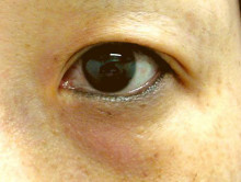 目のくま治療：ライトアイズウルトラ（light EYES ULTRA）