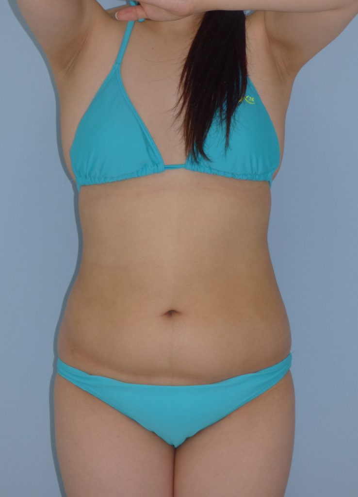 お腹の脂肪吸引　28歳 女性 150cm 56kg