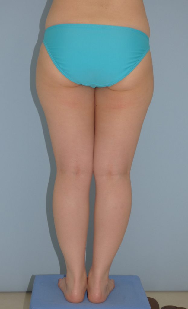 太もも - 脂肪吸引 症例写真（手術前）（後面）