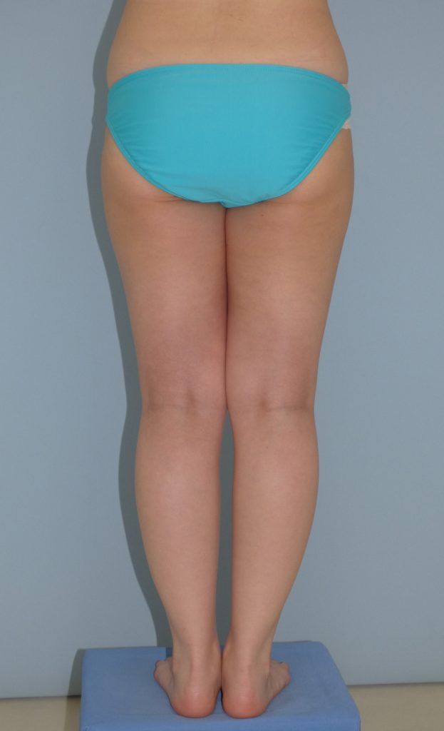 太もも - 脂肪吸引 症例写真（手術後2ヵ月）（後面）