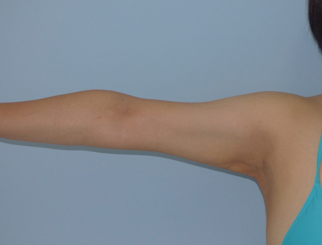 二の腕 - 脂肪吸引 症例写真（手術後3ヵ月）（挙上）
