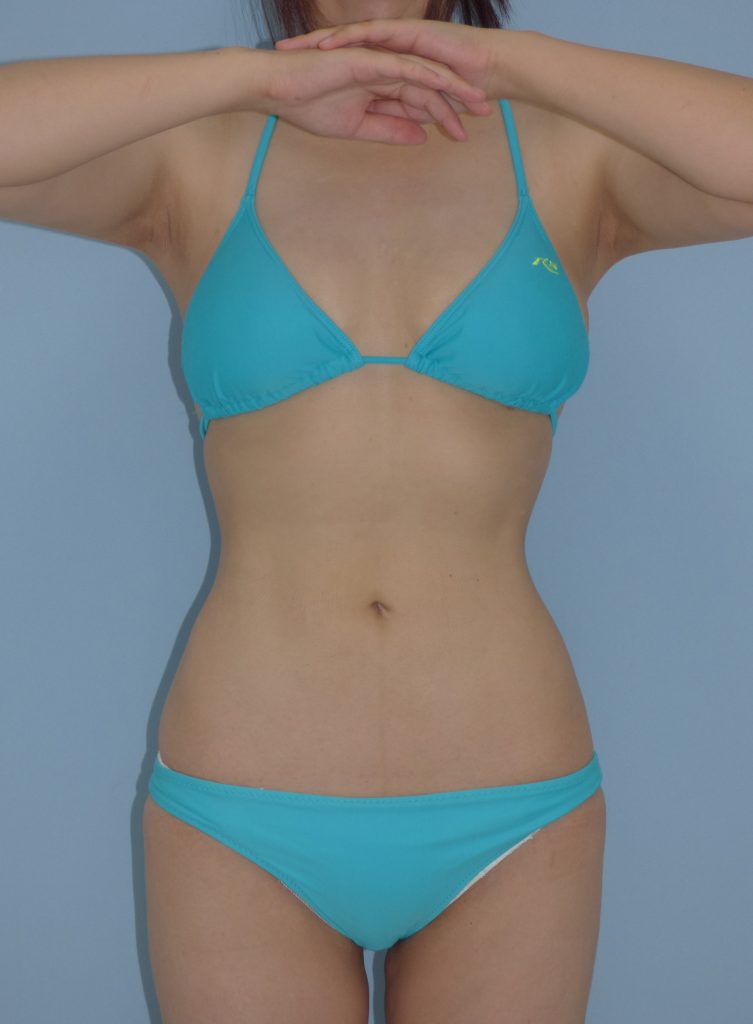 お腹 - 脂肪吸引 症例写真（手術後3ヵ月）（正面）