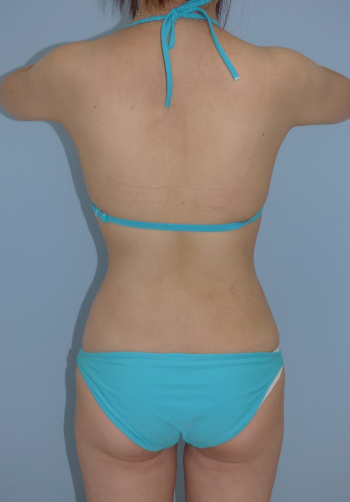 お腹 - 脂肪吸引 症例写真（手術後3ヵ月）（背面）