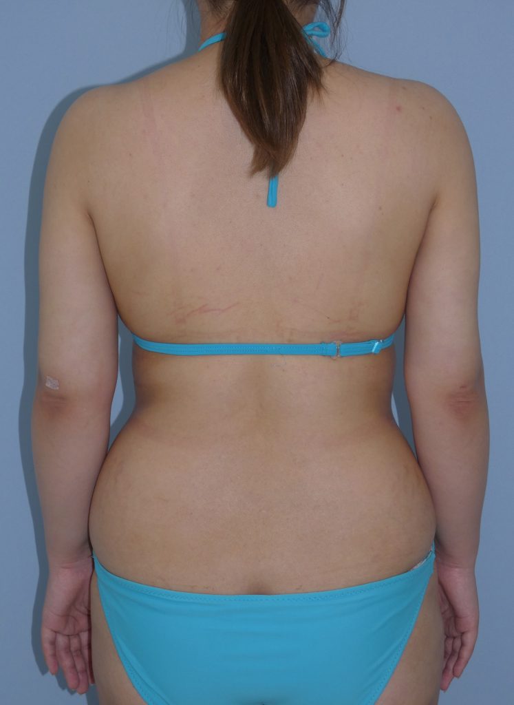 二の腕 - 脂肪吸引 症例写真（手術後1ヵ月）（後面）