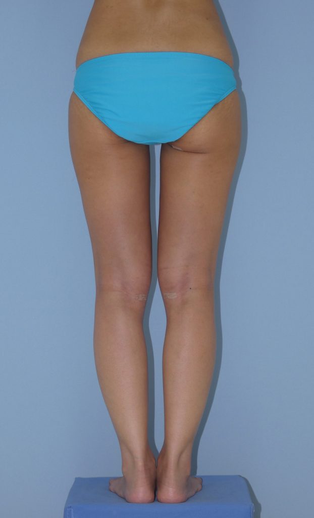 太もも - 脂肪吸引 症例写真（手術後1ヵ月）（後面）