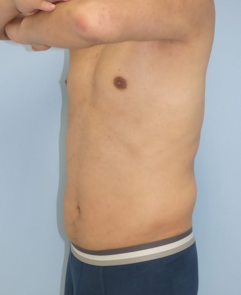 お腹 - 脂肪吸引 症例写真（手術前）（斜め）