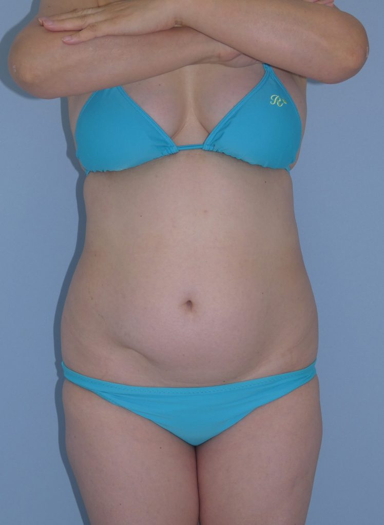お腹の脂肪吸引　53歳 女性 157cm 63kg