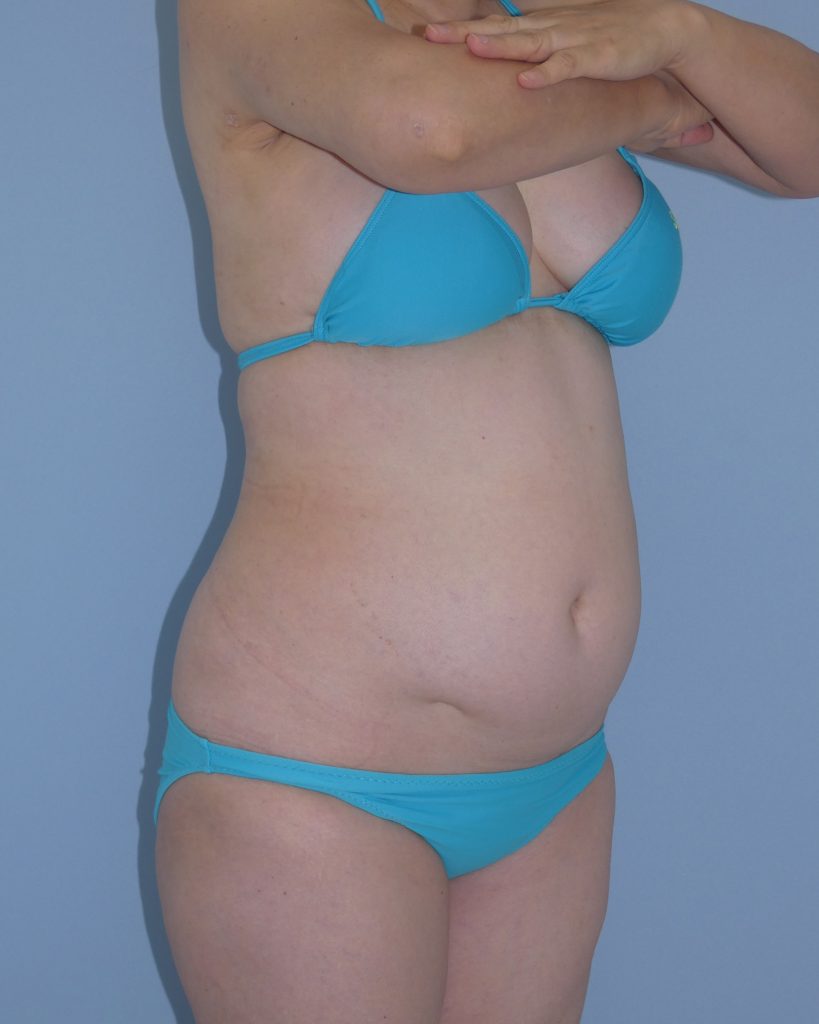 お腹 - 脂肪吸引 症例写真（手術前）（斜め）