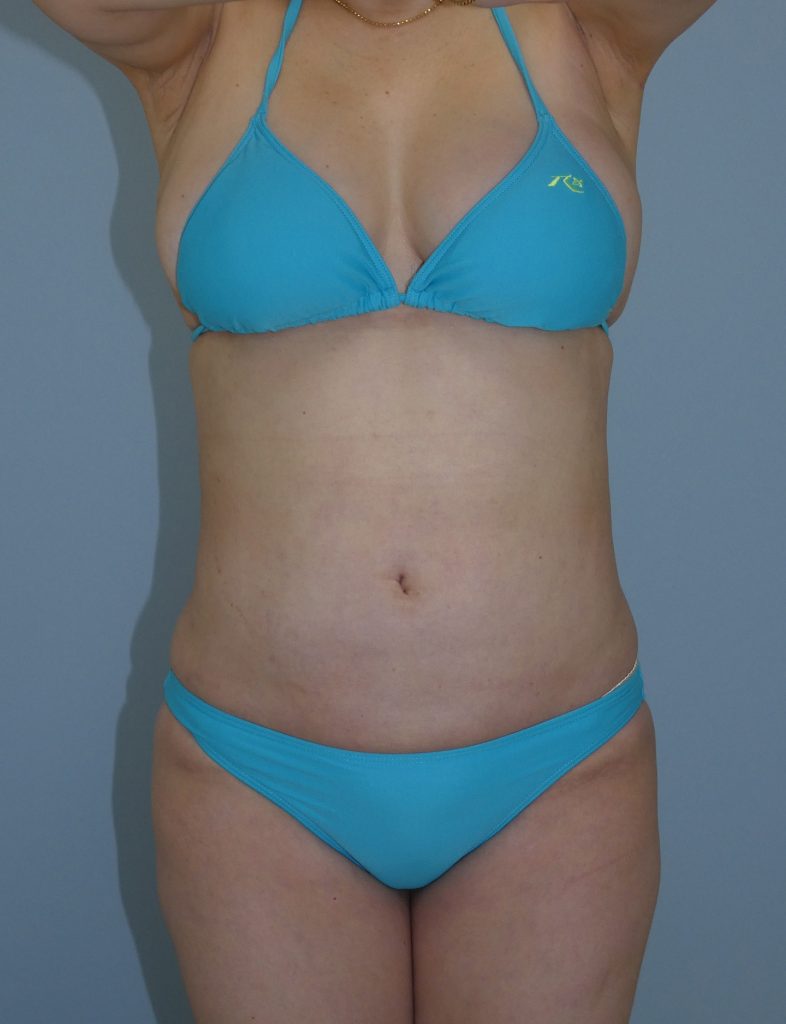 お腹 - 脂肪吸引 症例写真（手術後1ヵ月）（正面）