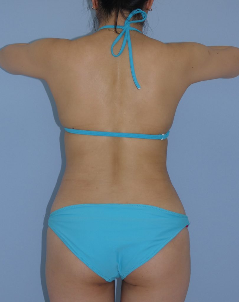 お腹 - 脂肪吸引 症例写真（手術後3ヵ月）（後面）