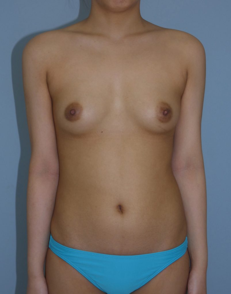 胸 - 脂肪注入 症例写真（手術前）（正面）